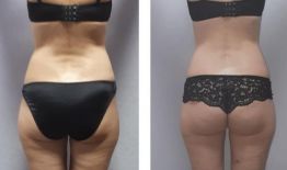 Lpg массаж для тела