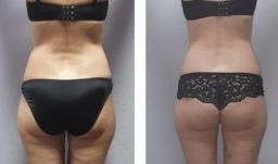 Lpg массаж для тела