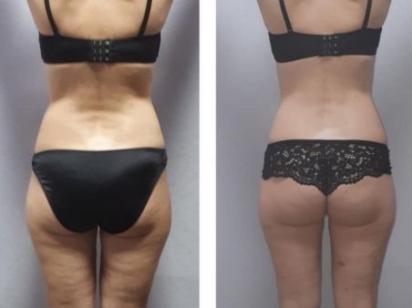 Lpg массаж для тела