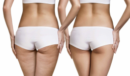 Абонемент на Lpg массаж тела 45