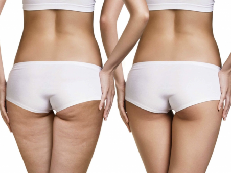 Абонемент на Lpg массаж тела 45